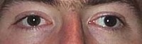 A mild case of strabismus
